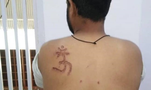 Symbol OM Burn Imprinted On Muslim Inmate in Tihar, Delhi Court Orders Enquiry Symbol OM Burn Imprinted On Muslim Inmate in Tihar, Delhi Court Orders Enquiry
